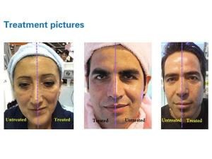  HIFU Facial Collagen Remodeling Machine, FG 660-D 